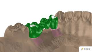 BEGO Semados Universal Abutment no Hex