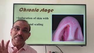 Nasal vestibulitis (Malayalam) Patient teaching programme