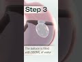 Allurion Gastric Balloon - A Simple Solution to Lasting Weight Loss