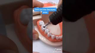 How to Fill a Cavity