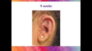 Microtia Ear Surgery - The Healing Process with the Porous Implant Ear Reconstruction technique