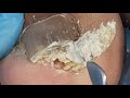 Most satisfying Ingrown toenail removal on the enternet