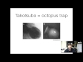 5 minute refresher- Takotsubo