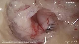 Endoscopic approach intralabyrinthine schwannoma - Prof. Marchioni - Uni Hospital, Verona (Italy)