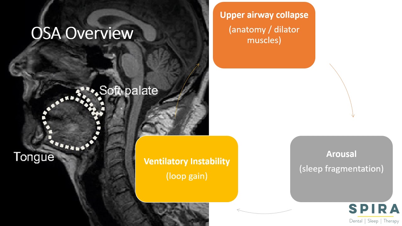 Obstructive Sleep Apnea Overview