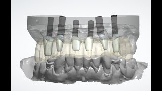 รากฟันเทียมทั้งปาก แบบ all on 4-6 เทคโนโลยีสมัยใหม่การวางแผนรักษาโดยระบบดิจิตอล