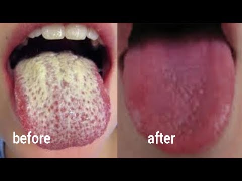EASY AND NATURAL WAY TO CLEAN DIRTY TONGUE AND REMOVE BAD BREATH EASY AND NATURAL WAY TO CLEAN DIRTY TONGUE AND REMOVE BAD BREATH