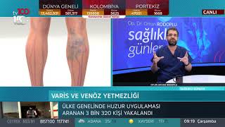 Varis ve venöz yetmezliği - Op. Dr. Orhan Rodoplu - Sağlıklı Günler - 15 Temmuz 2020