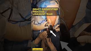 लिगामेंट सर्जरी में ग्राफ्ट कैसे लेते हैं💥Graft Harvesting Process #ligamentinjury #kneeligament