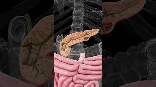 🔬 Mucinous Cystic Neoplasm of the Pancreas: Understanding the Risks