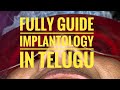 Fully guided implantology in Telugu || Dr. Samuel Simpsy || Latha’s Dentist and Dontist