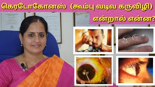 Keratoconus (கூம்பு வடிவ கருவிழி) எப்படி வருகிறது?