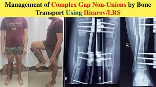 Management of Complex Gap Non-Unions by Bone Transport Using Ilizarov/LRS