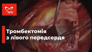 Тромбектомія з лівого передсердя 🔷 Інститут серця