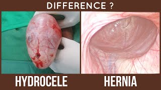 HYDROCELE vs HERNIA - Difference
