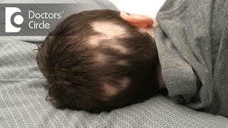 How to manage bald spot due to Alopecia Areata? - Dr. Rashmi Ravindra