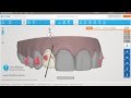 Invisalign ClinCheck Pro Tutorial: espaciado con stripping - Ortodoncia Friedländer Barcelona