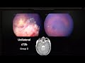 Retinoblastoma Pathology - Dr. Brenda Gallie