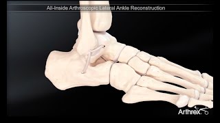 Dr Bruno LEVY - Ligamentoplastie de la cheville sous arthroscopie