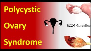 Polycystic Ovary Syndrome (PCOS) : Symptoms, Causes, Diagnosis and Treatment; RCOG Guideline