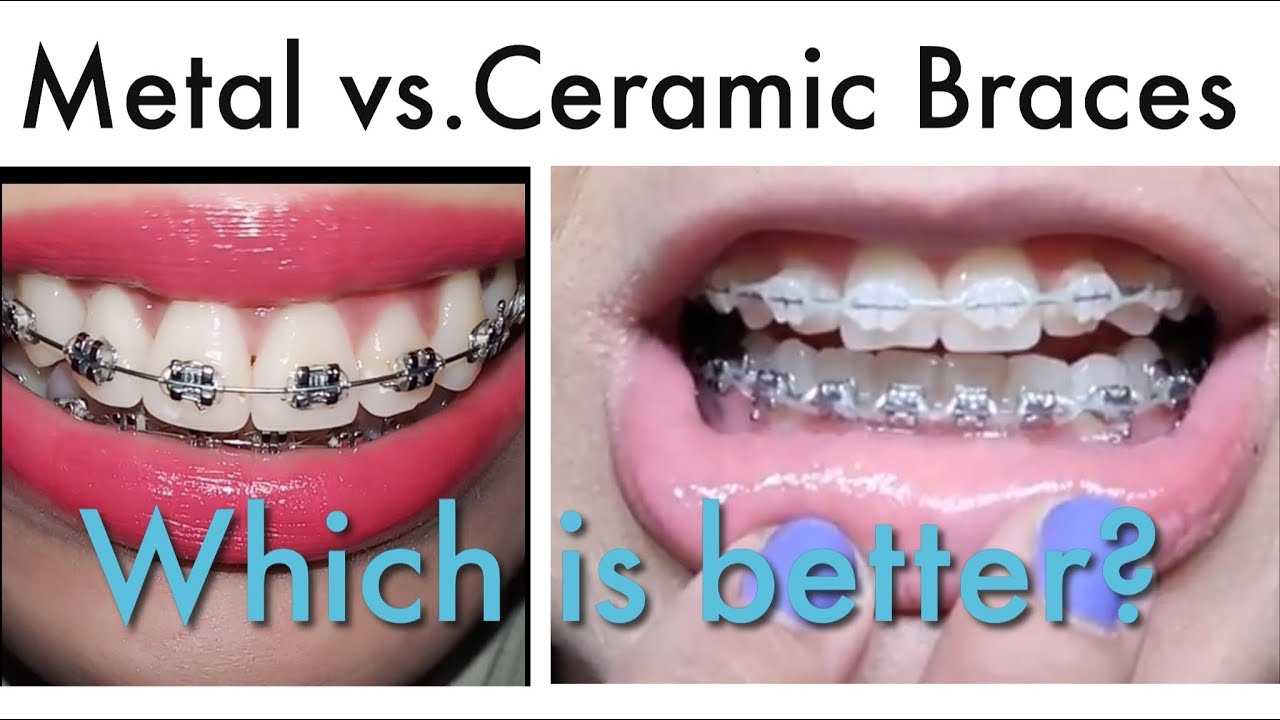 Ceramic Braces Vs Metal Braces Cost Pros Cons Pictures 53 Off