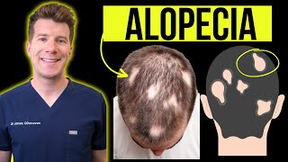 Doctor explains Alopecia Areata (aka patchy or total hair loss) - Signs, Symptom