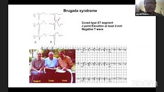 ECG- Interpretation in children- Dr Jayakrishnan