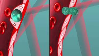 Animation of tumor cells extravasating through angiopellosis and diapedesis