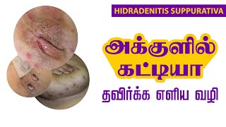 அக்குளில் கட்டியா தவிர்க்க எளிய வழி | Hidradenitis Suppurativa Treatment in Tamil | JKT SKIN