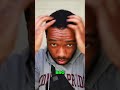 Quick Hair Transplant update 👨🏾‍🦲‼️ #skincare