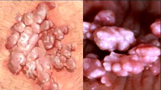 Genital Warts (Condyloma Accuminata) Are Common; Causes, Signs, Symptoms, Treatment, HPV 6-11