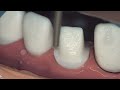 adex 9 ceramic crown preparation fixed prosthodontics