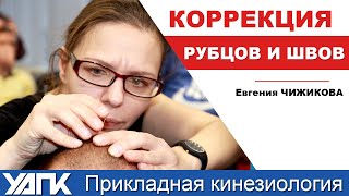 Коррекция рубцов и швов (Е.Чижикова)