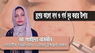 ব্রণের কালো দাগ ও গর্ত দূর করার উপায় || Acne Removal Blackheads || Pimples Removal Face wash