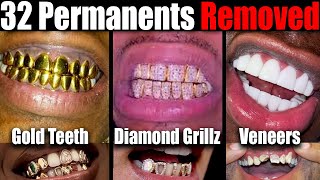 32 Permanent Gold Teeth Removed After 20 Years, The Effects Of Permanent Grillz