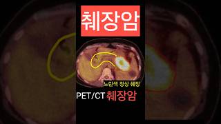 췌장암 CT MRI PET/CT 진단