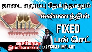 எலும்பு தேய்ந்தாலும் முழு fixed பல்/ zygomatic பல் இம்ப்ளாண்ட் சிகிச்சை/Zygomatic Implant in Tamil