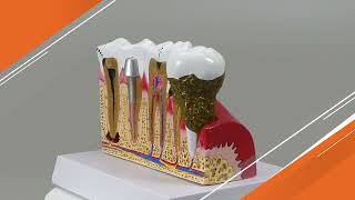 Diseased Teeth and Gums Model | AnatomyStuff