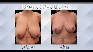 Why You Should Consider Breast Reduction Surgery