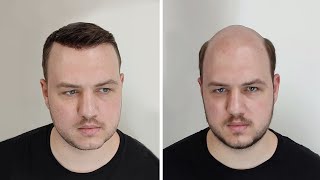 התהליך של ולד | יחידת שיער | David Hair Solutions