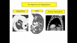 12DaysinMarch, Pulmonary Fungus (Part II) - Opportunistic Yeast and Mold for USMLE Step One