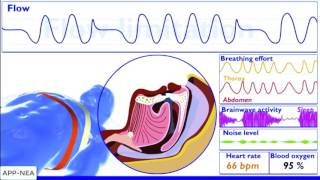 Pathophysiology of OSA