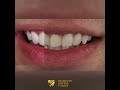 e max laminate veneers