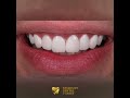 e max laminate veneers