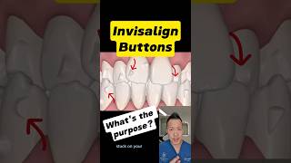 How Invisalign Attachments Work: The Key to Faster Results! #dentallan #dentist #shorts