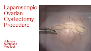 Laparoscopic Ovarian Cystectomy Surgery with Dr. Susan Kahlil | J\u0026J MedTech