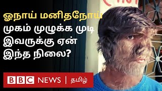 ஓநாய்-மனித நோய்: 17 வயது சிறுவன் இப்படி அவதிபடுவது ஏன்? இதற்கு Treatment உண்டா? | Werewolf Syndrome