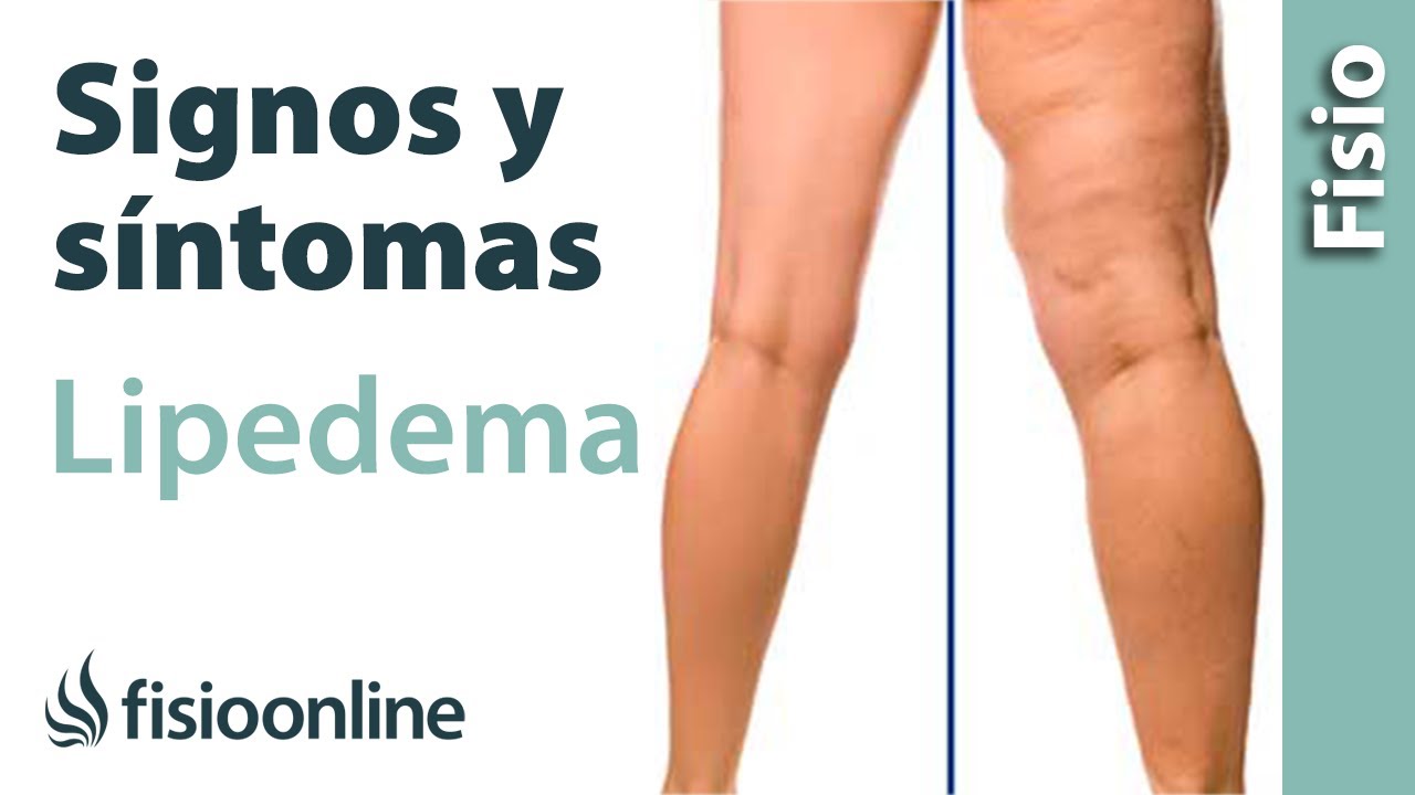 SIGNOS y SÍNTOMAS para el DIAGNÓSTICO del LIPEDEMA🦵🏻