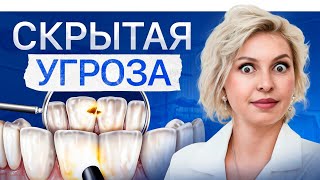 Этот вид кариеса есть у более 70% людей! Контактный кариес