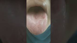 A case of  tongue ulcer একটি জিহ্বা আলসারের রোগী